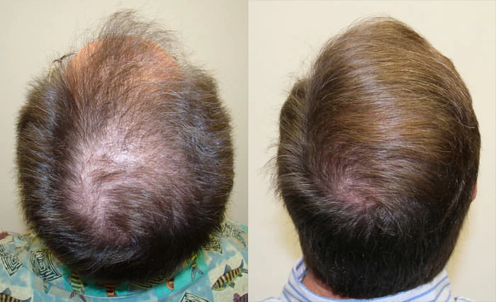 Patient p34 hair transplant before and after crown view