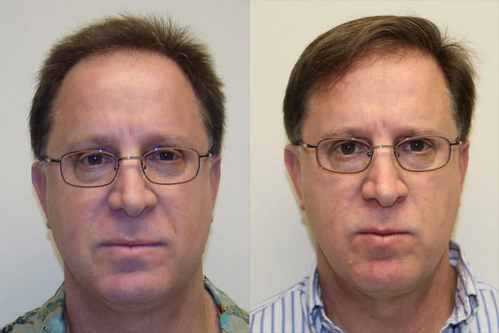 David Hair Transplant Before and After