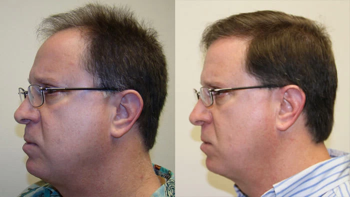 Patient p34 hair transplant before and after left view