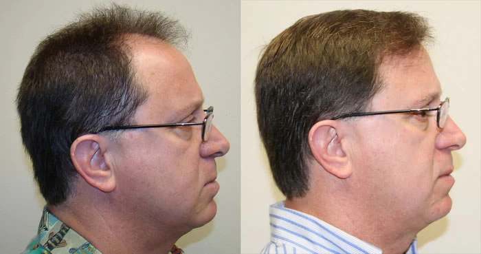Patient p34 hair transplant before and after right view