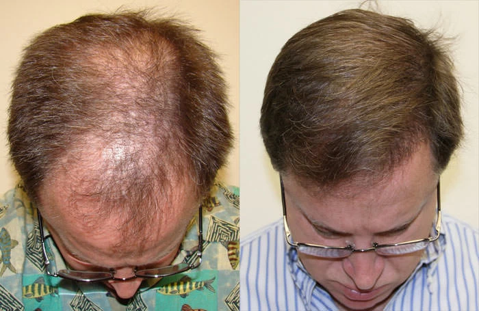 Patient p34 hair transplant before and after tilt view