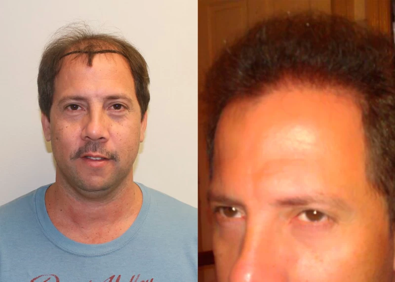 Patient 351 Hair Transplant Before and After
