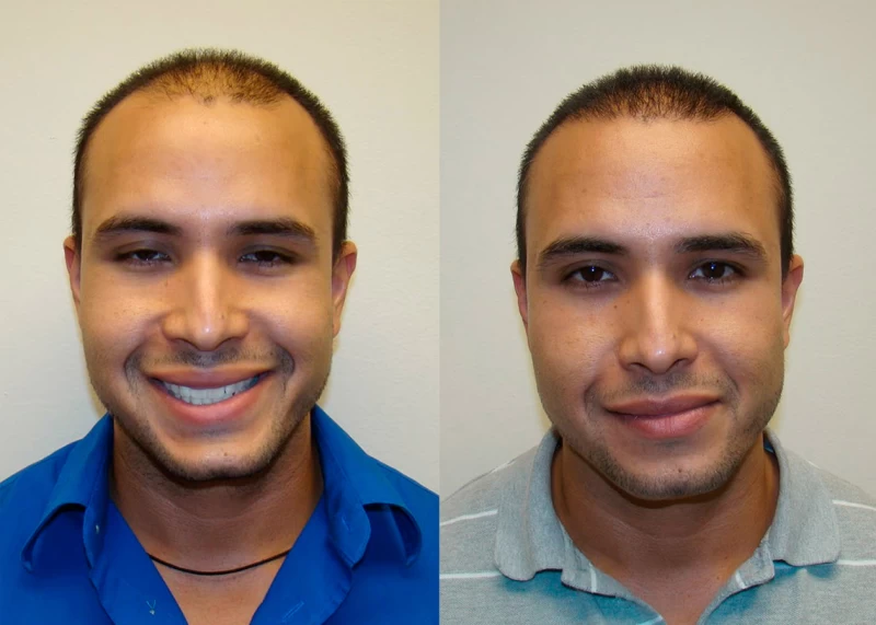 Patient 352 Hair Transplant Before and After