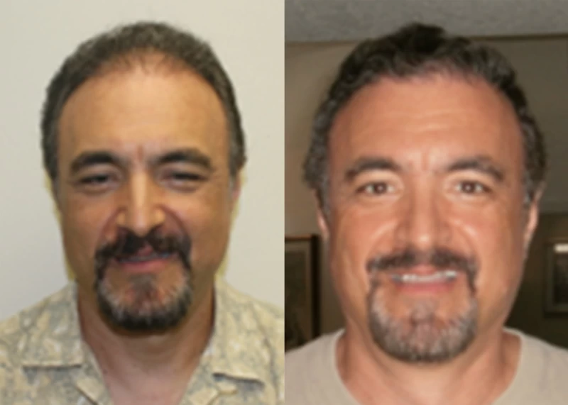 Patient 353 Hair Transplant Before and After