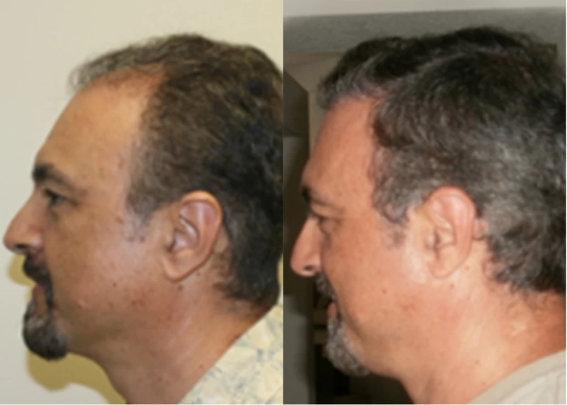 Patient p353 hair transplant before and after left view