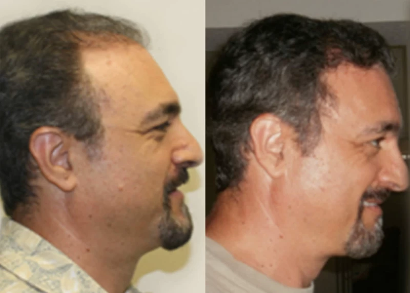 Patient p353 hair transplant before and after right view