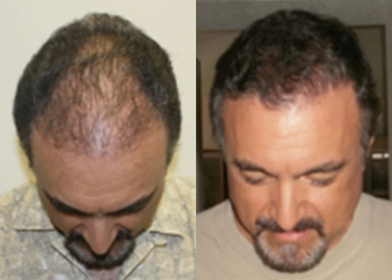 Patient p353 hair transplant before and after tilt view