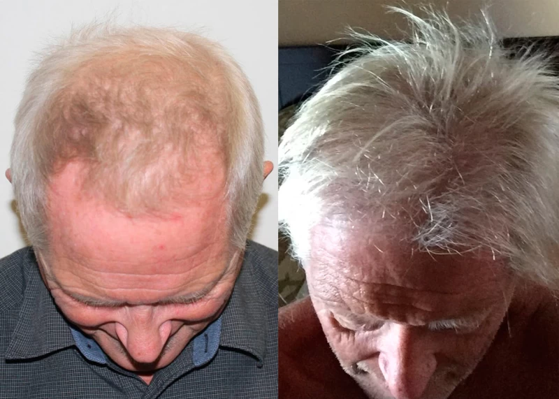 Patient 354 Hair Transplant Before and After