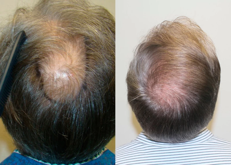Patient p355 hair transplant before and after crown view