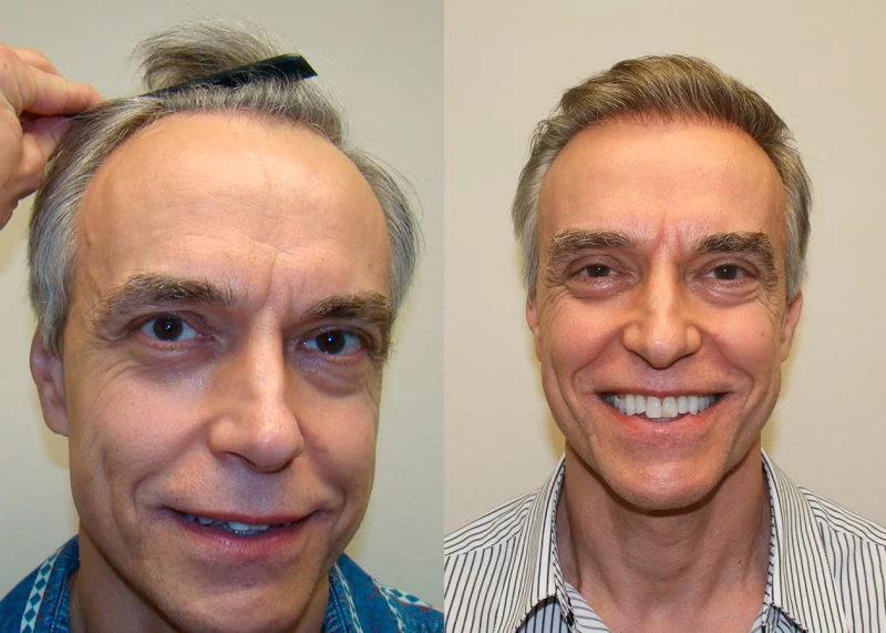 Patient 355 Hair Transplant Before and After