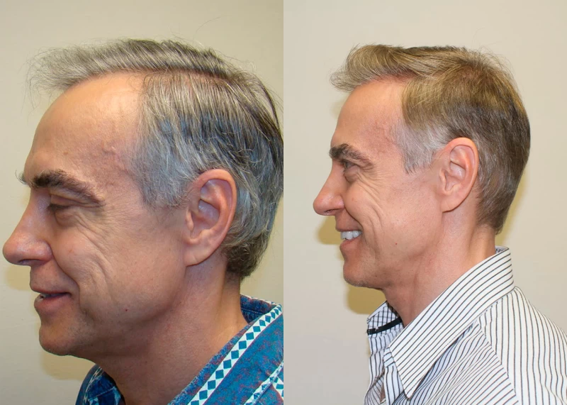 Patient p355 hair transplant before and after left view