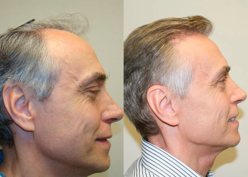 Patient p355 hair transplant before and after right view