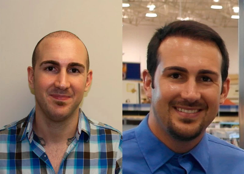 Patient 357 Hair Transplant Before and After
