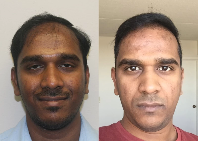Patient 358 Hair Transplant Before and After
