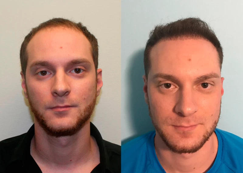 Patient 359 Hair Transplant Before and After