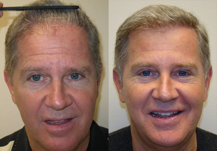 Curt Hair Transplant Before and After