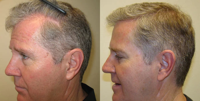 Patient p35 hair transplant before and after left view