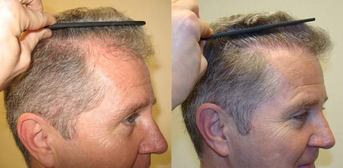 Patient p35 hair transplant before and after right view