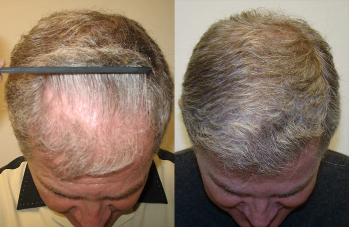 Patient p35 hair transplant before and after tilt view