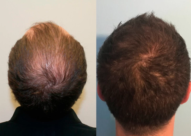 Patient p360 hair transplant before and after crown view