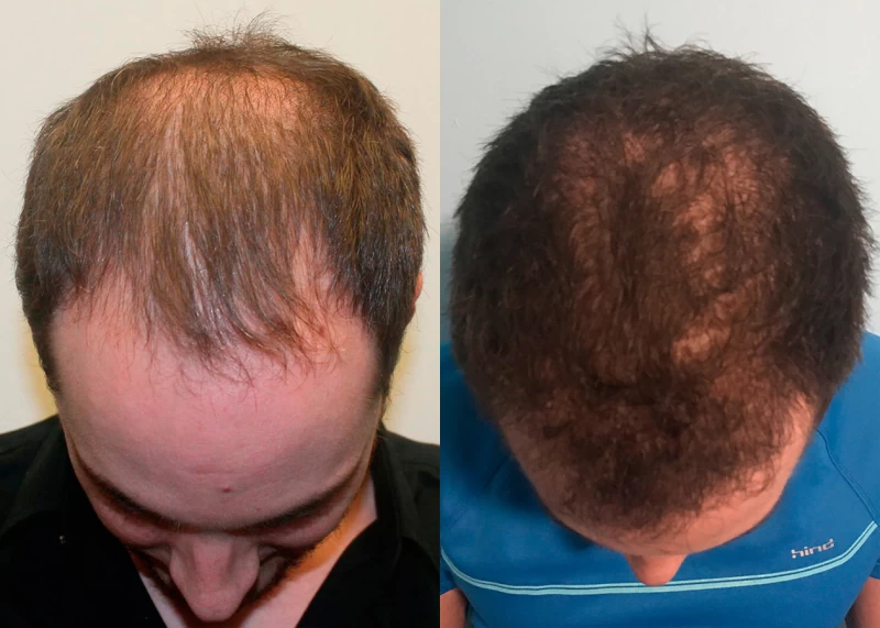 Patient 360 Hair Transplant Before and After