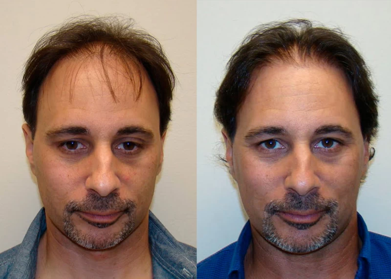 Patient 361 Hair Transplant Before and After