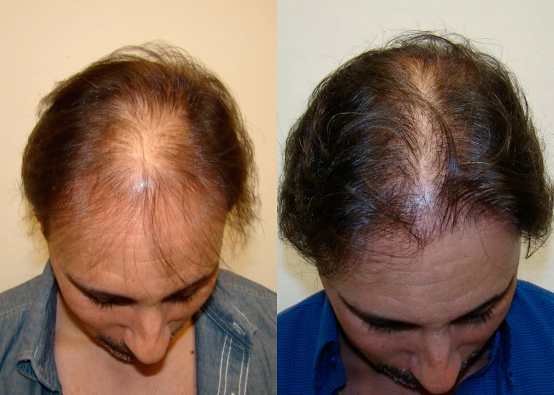 Patient p361 hair transplant before and after tilt view