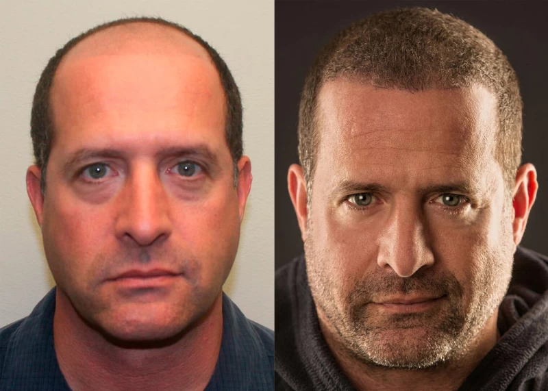 Patient 363 hair transplant before and after results