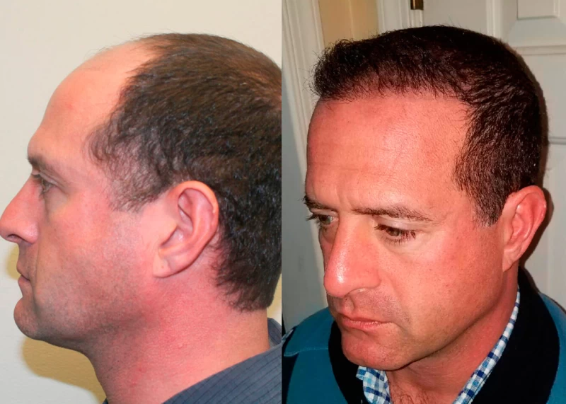 Patient p363 hair transplant before and after left view