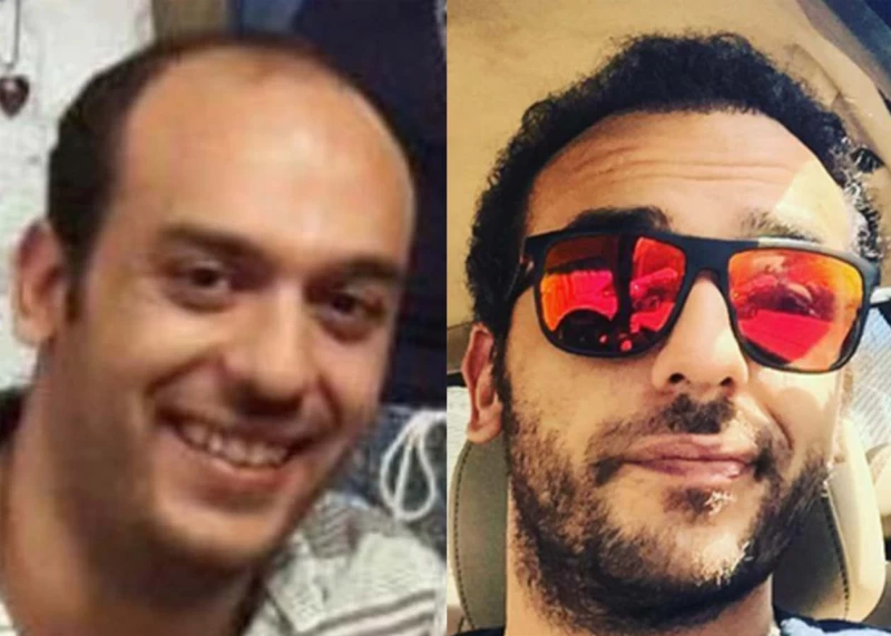 Patient 365 Hair Transplant Before and After