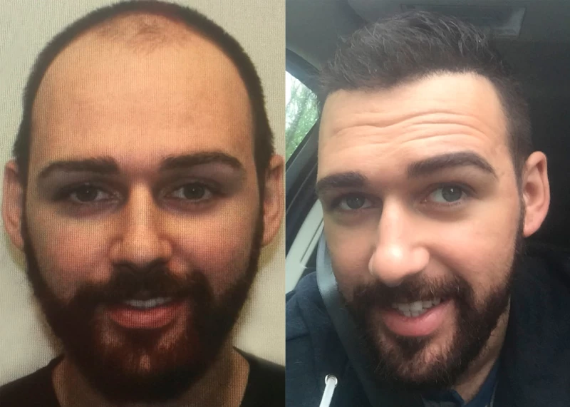 Patient 366 Hair Transplant Before and After