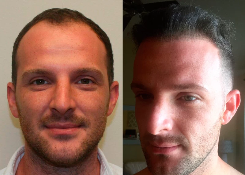 Patient 367 Hair Transplant Before and After