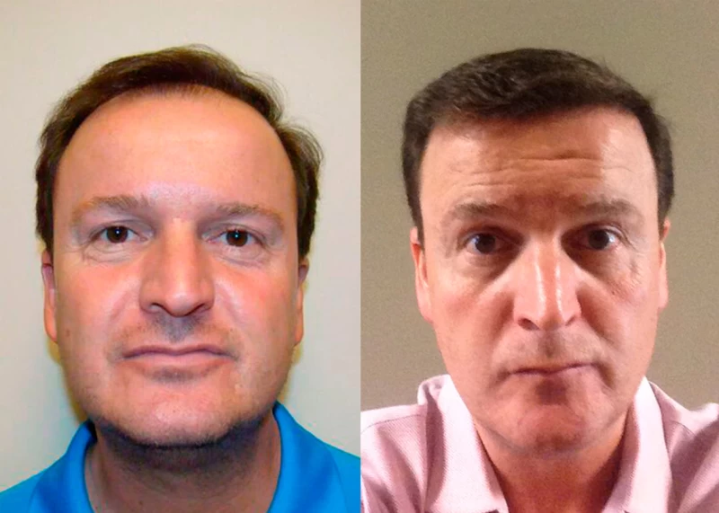 Patient 368 Hair Transplant Before and After
