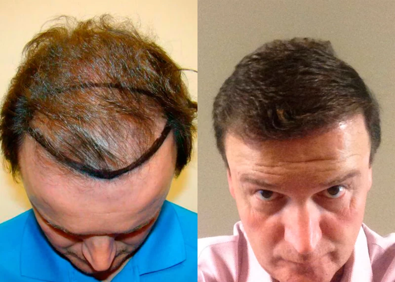 Patient p368 hair transplant before and after tilt view