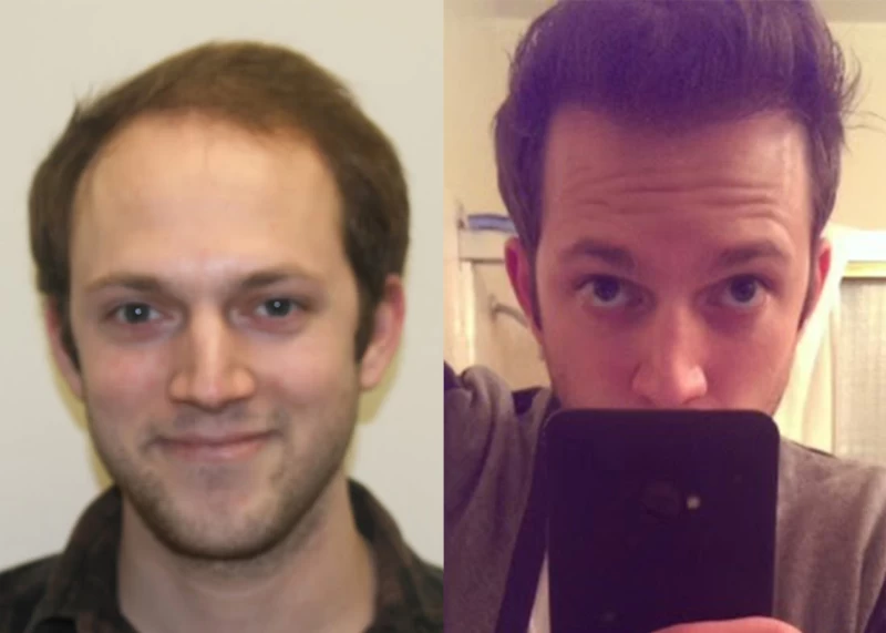 Patient 369 Hair Transplant Before and After