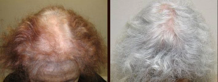 Patient 36 Hair Transplant Before and After