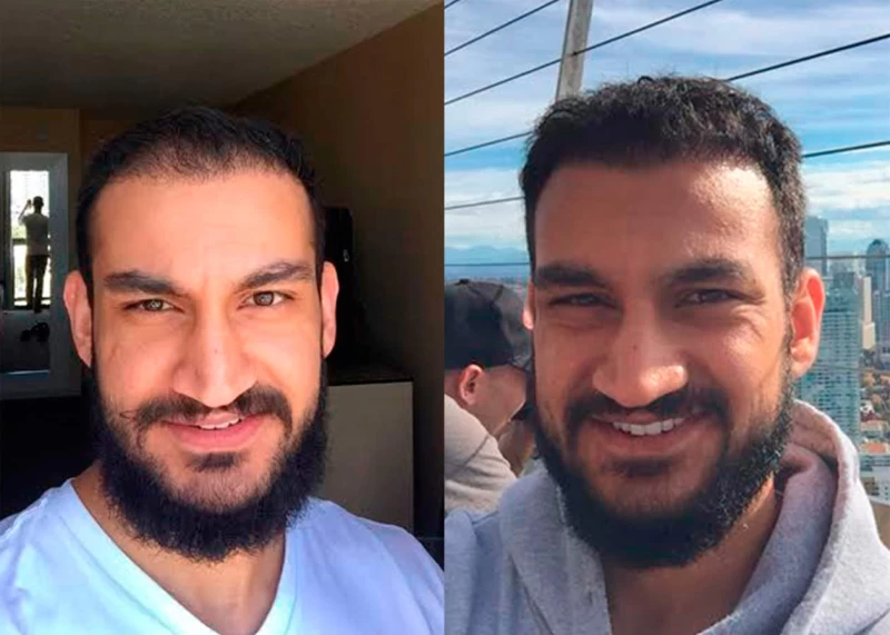 Patient 370 Hair Transplant Before and After