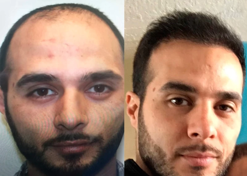 Patient 371 Hair Transplant Before and After
