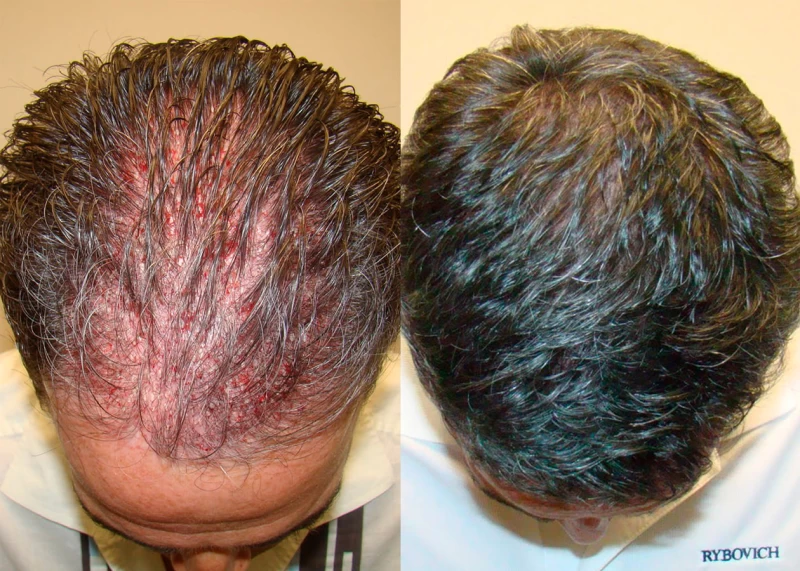 Patient 372 Hair Transplant Before and After