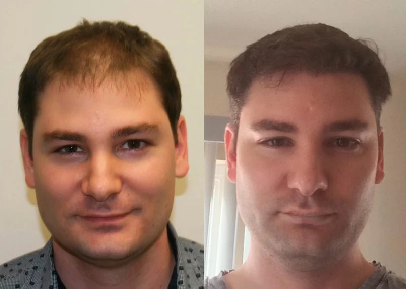 Patient 373 Hair Transplant Before and After