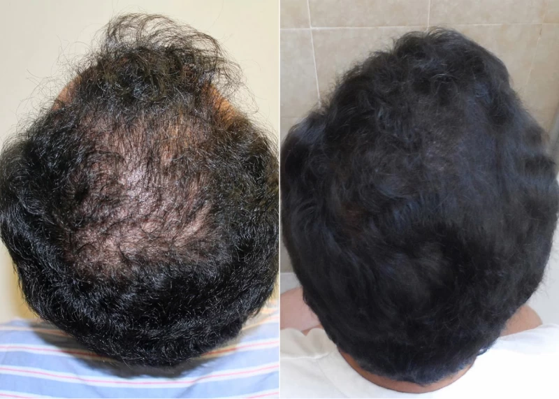 Patient p374 hair transplant before and after crown view