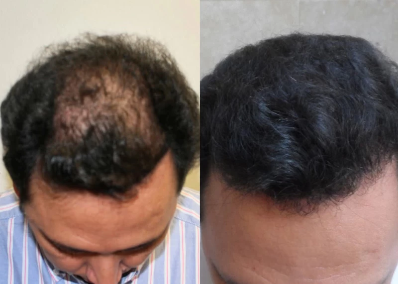 Patient 374 Hair Transplant Before and After