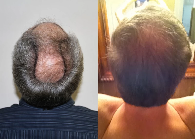Patient p375 hair transplant before and after crown view