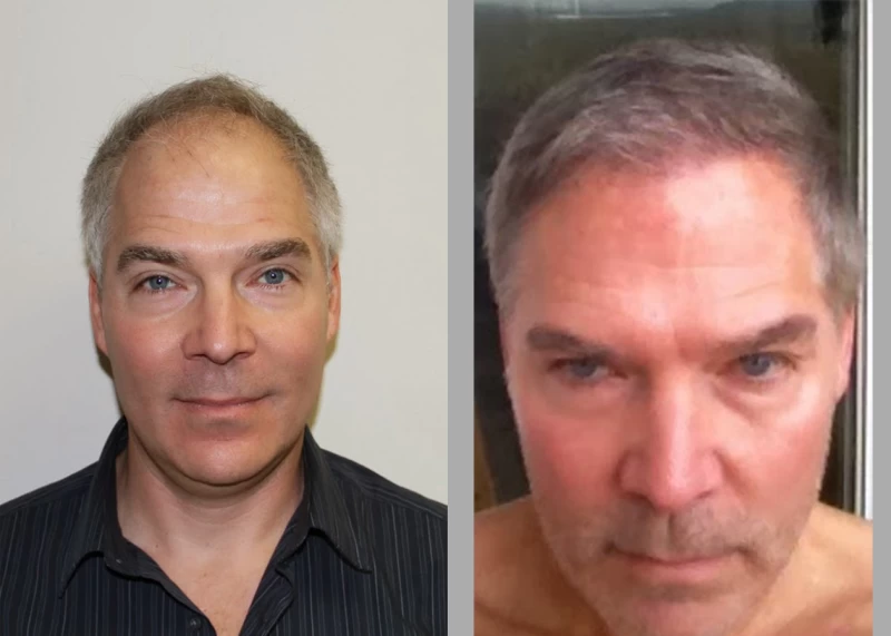 Patient 375 Hair Transplant Before and After