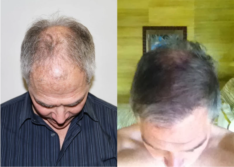 Patient p375 hair transplant before and after tilt view