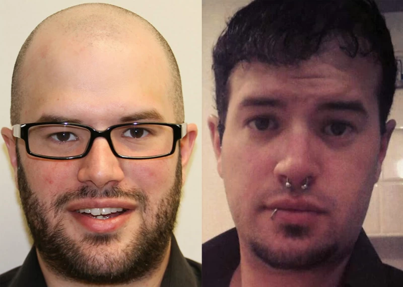 Patient 376 Hair Transplant Before and After