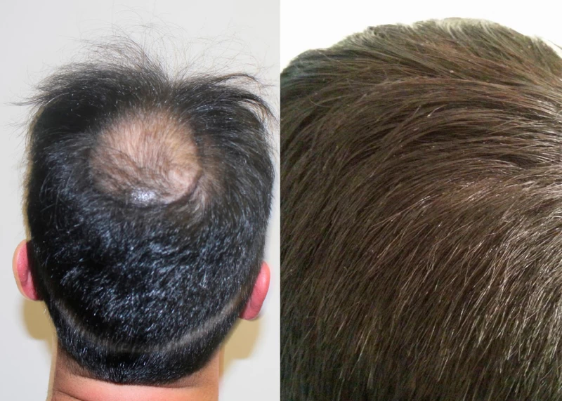 Patient p377 hair transplant before and after crown view