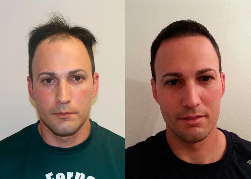 Patient 377 Hair Transplant Before and After