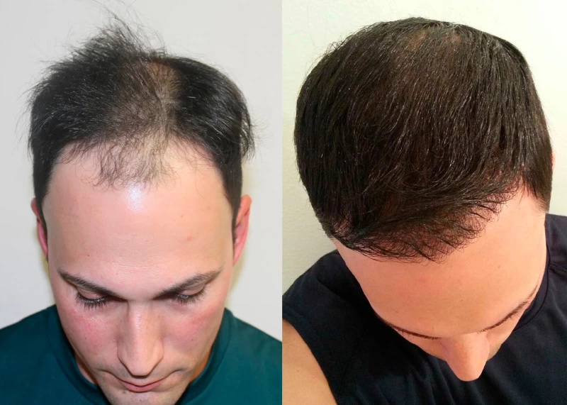 Patient p377 hair transplant before and after tilt view