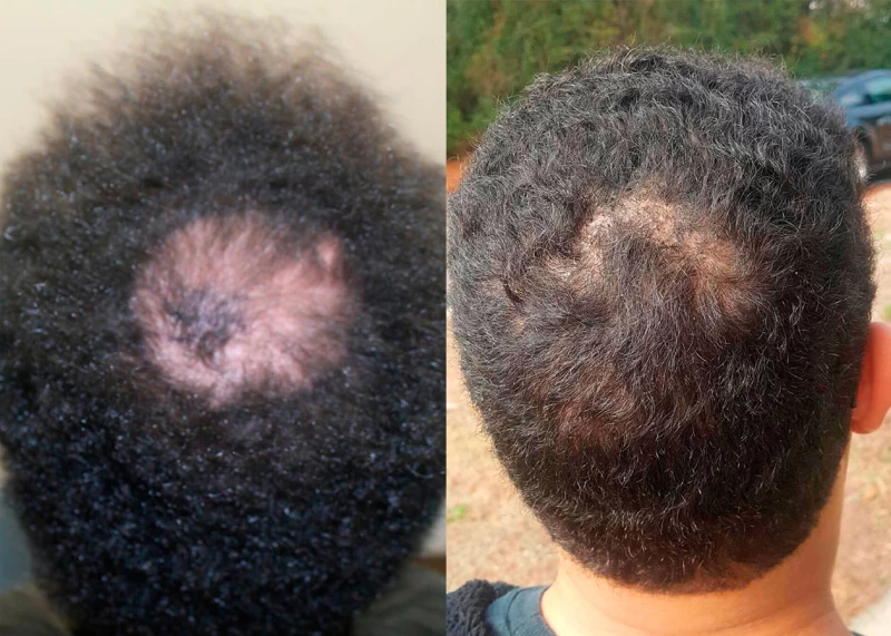 Patient p378 hair transplant before and after crown view